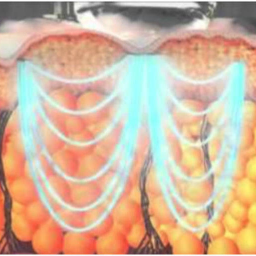 应该每个入仪器坑的仙女都听说过Tripollar吧～ 💙我