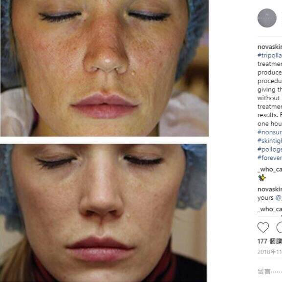 史上最认真的一次科普💙关于Tripollar（含不同型号对