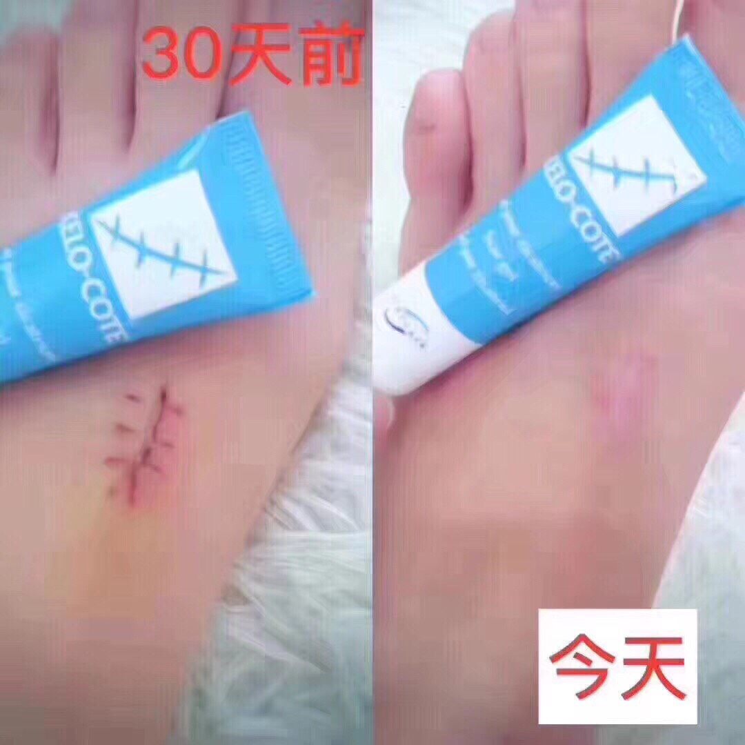 好物种草，祛疤神器，美国疤克膏15g  绝对的祛疤小能手！国