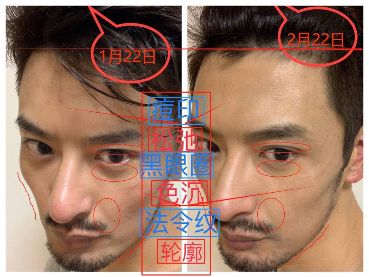 #美容仪大比拼# Nuface对面部轮廓的改善。 前提：废话