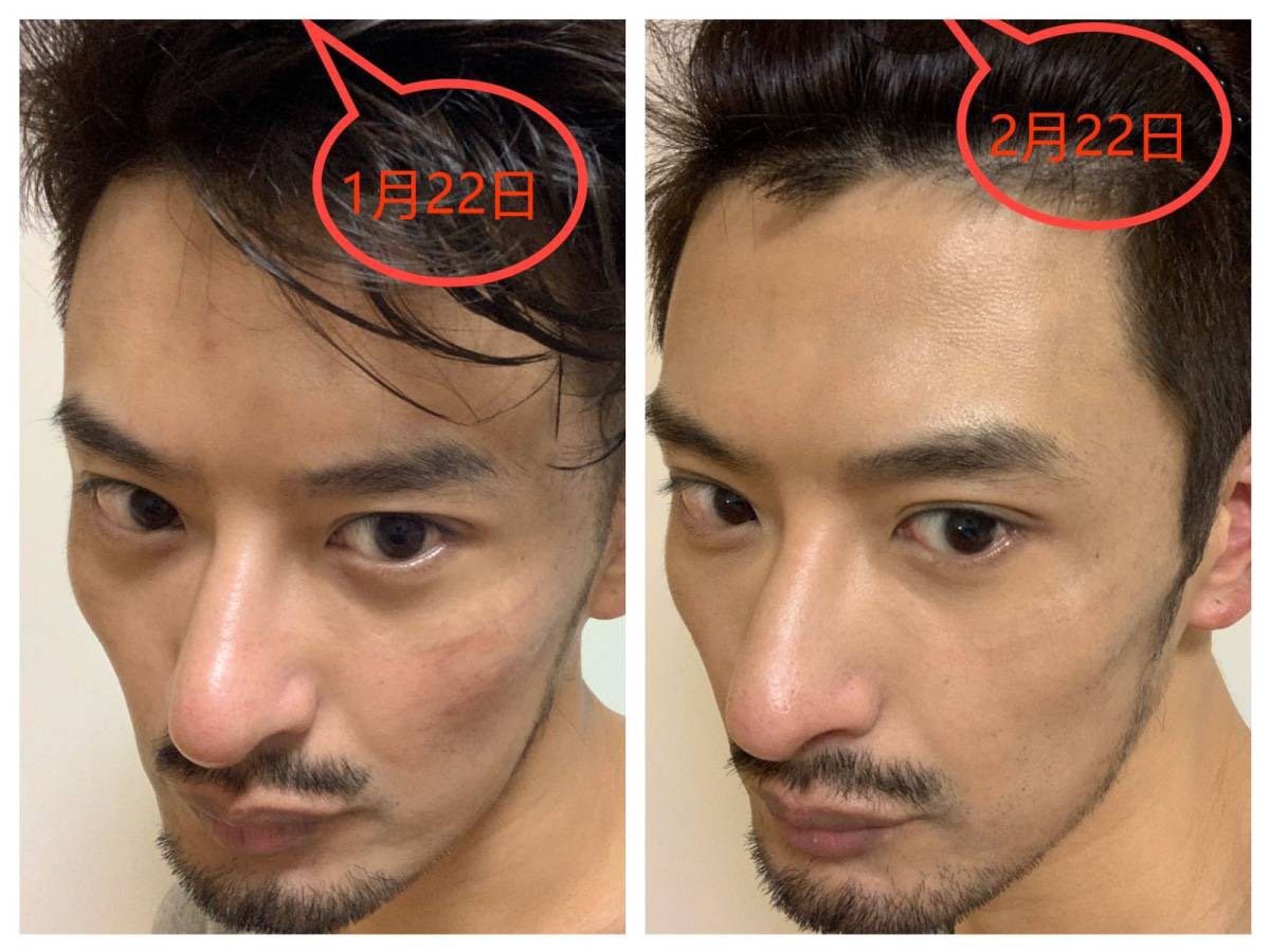 #美容仪大比拼# Nuface对面部轮廓的改善。 前提：废话