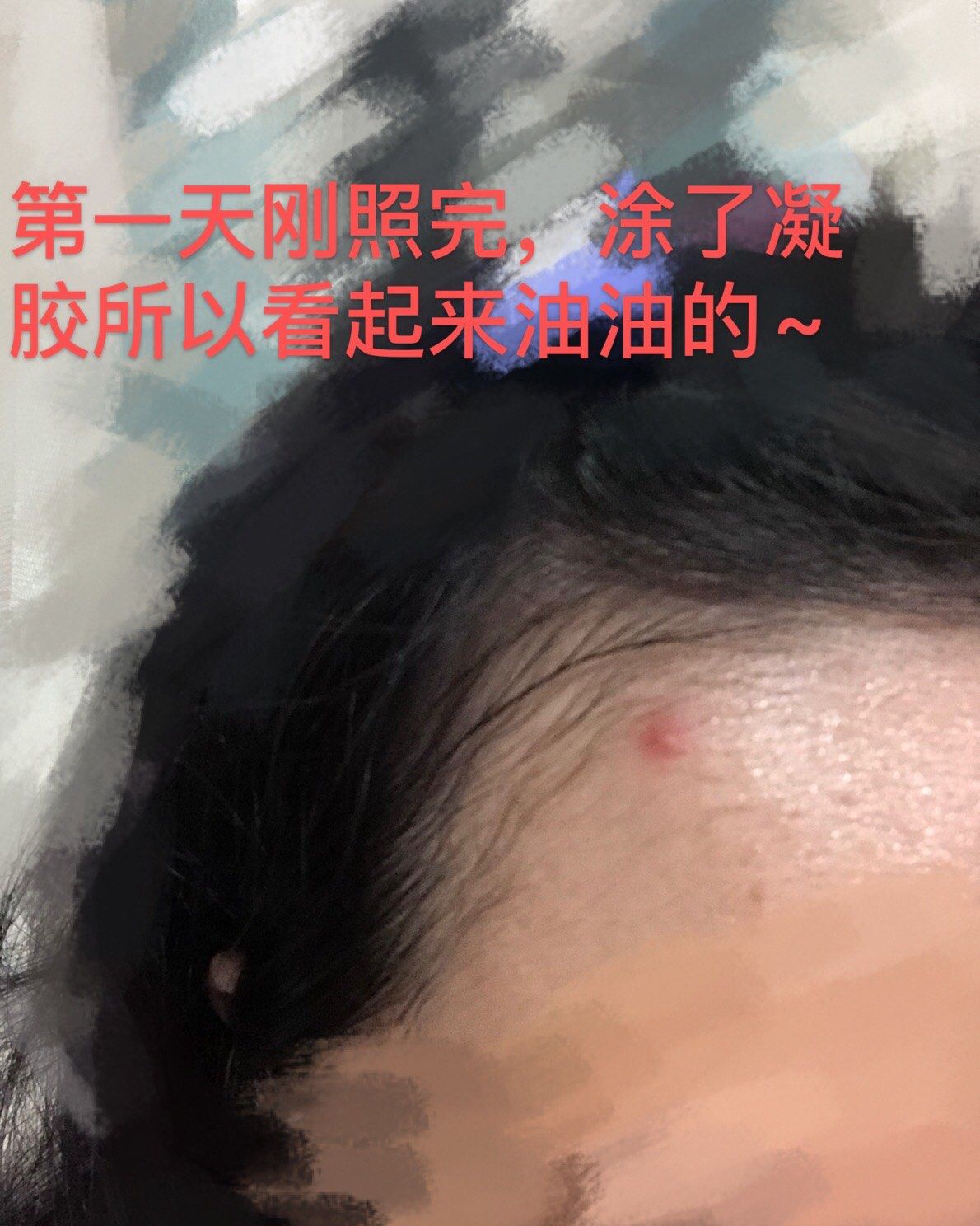 来了exideal小排灯来了，内含p2祛痘测评 🐝本人皮肤