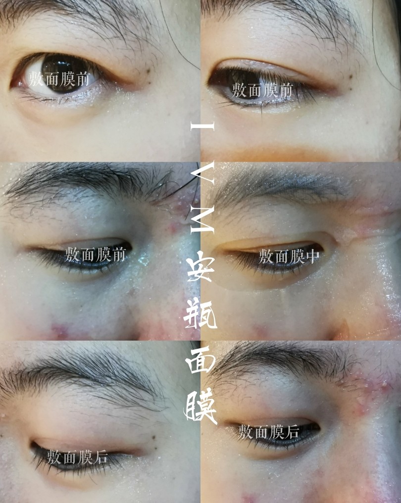 IVM安瓶面膜  淡化痘印 晒后修复 收缩毛孔  我是混油皮