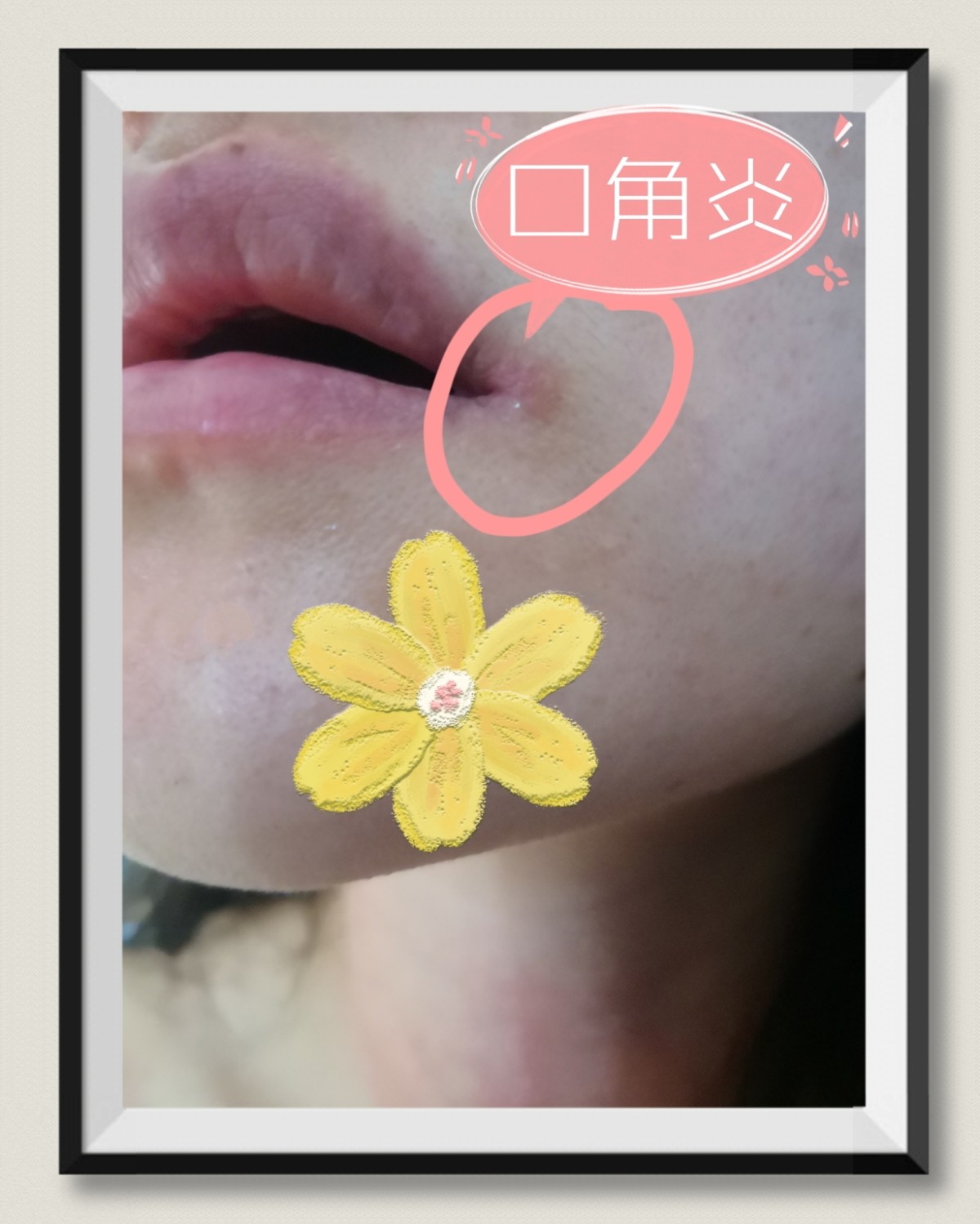 “烂嘴角”了咋办？--口角炎拯救计划   一、写在前面 当了