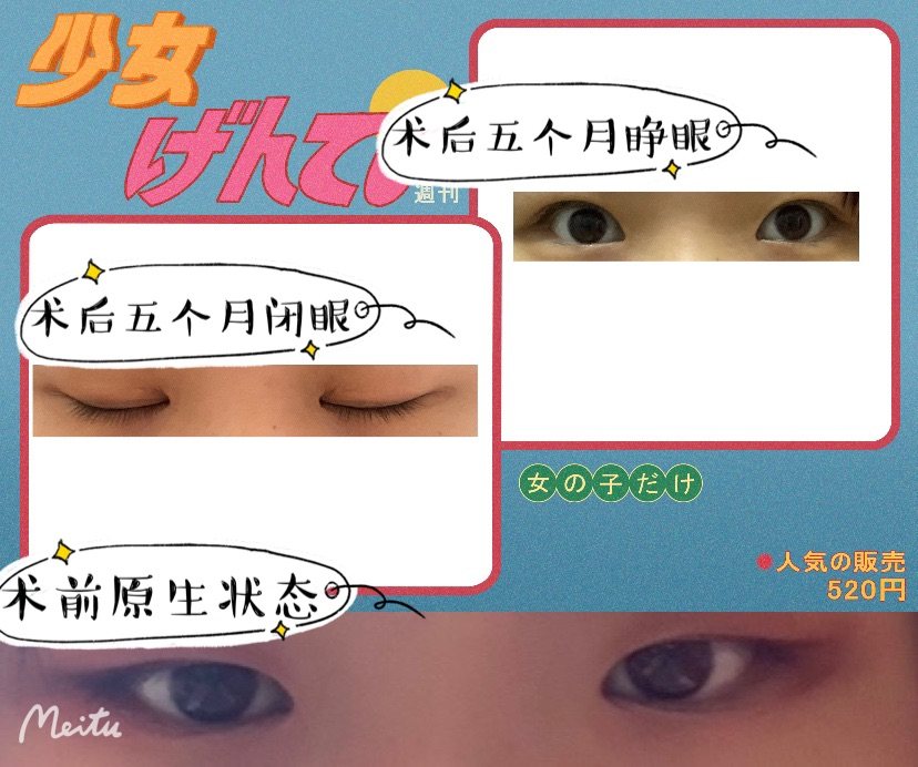 祛疤小能手！内含双眼皮手术分享 🍭如题，对于每一个想割双眼