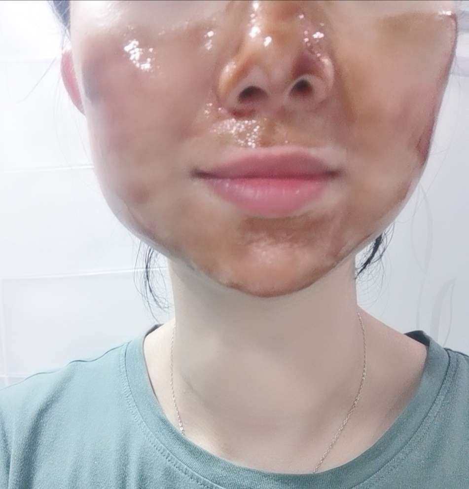 D1，今天来敷这款撕拉面膜。 最近鼻头和下巴的黑头都比较严重