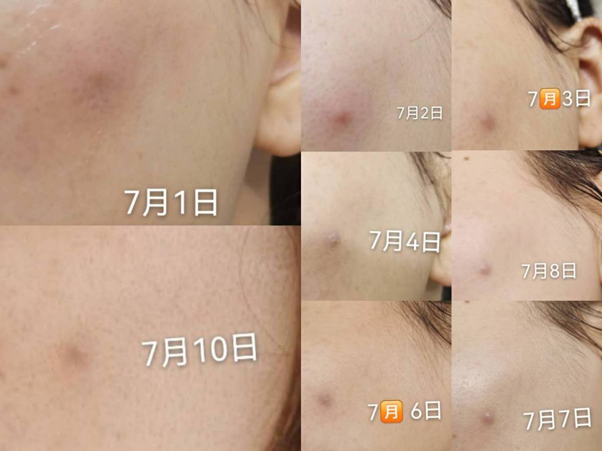 刷酸风大，大球也沉浸刷酸很久了~一个是宝拉珍选一个是博乐达水