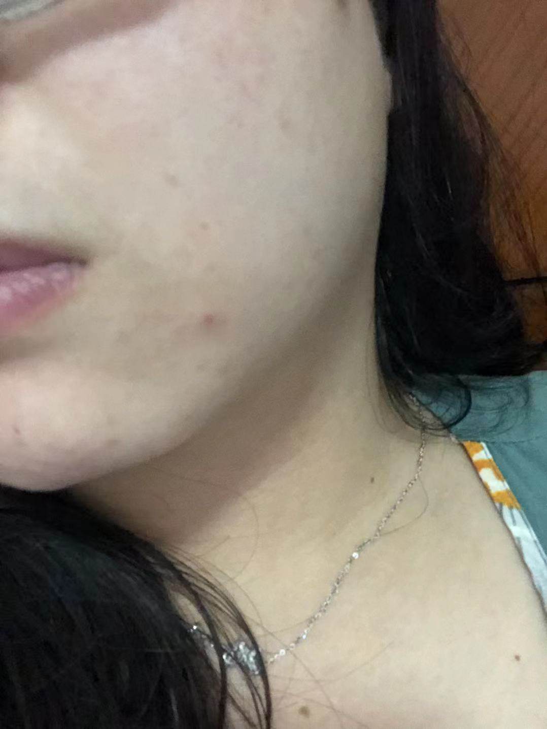 最晚上突然发现自己的右下巴长了一颗痘痘，虽然没有很严重，但是