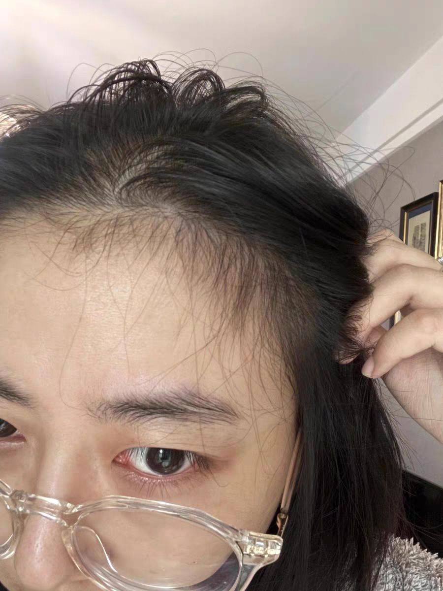 这两年脱发越来越严重了，我身边的损友也老爱刺激我，为了显头发