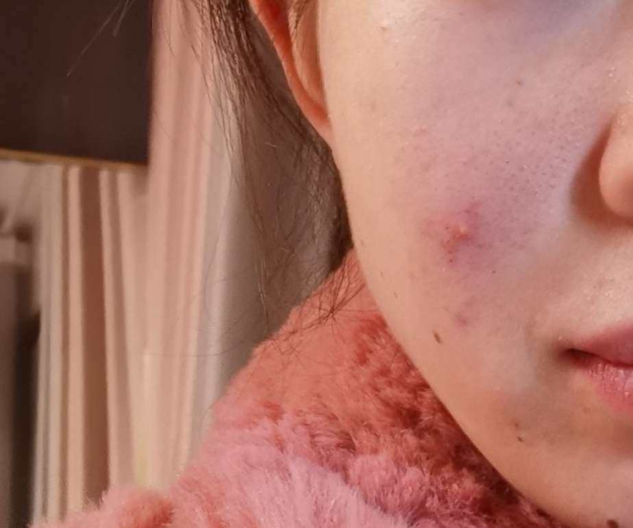 🦋肤质：本人额头闭口，消不下去的那种，唇周爱长痘，几乎就是