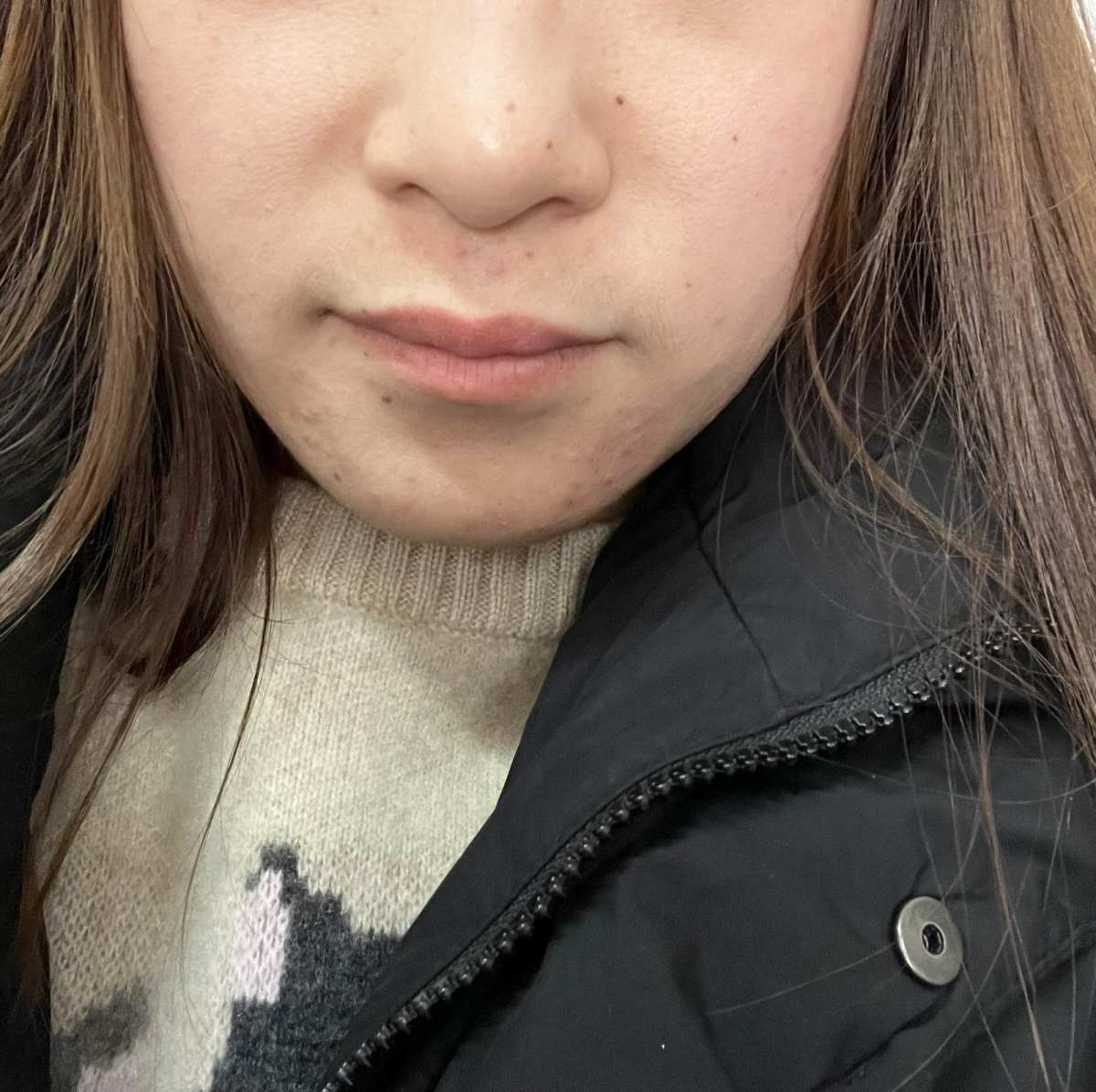 反反复复的冒痘痘，简直就是毁容！😭 18岁都没有长过痘痘，