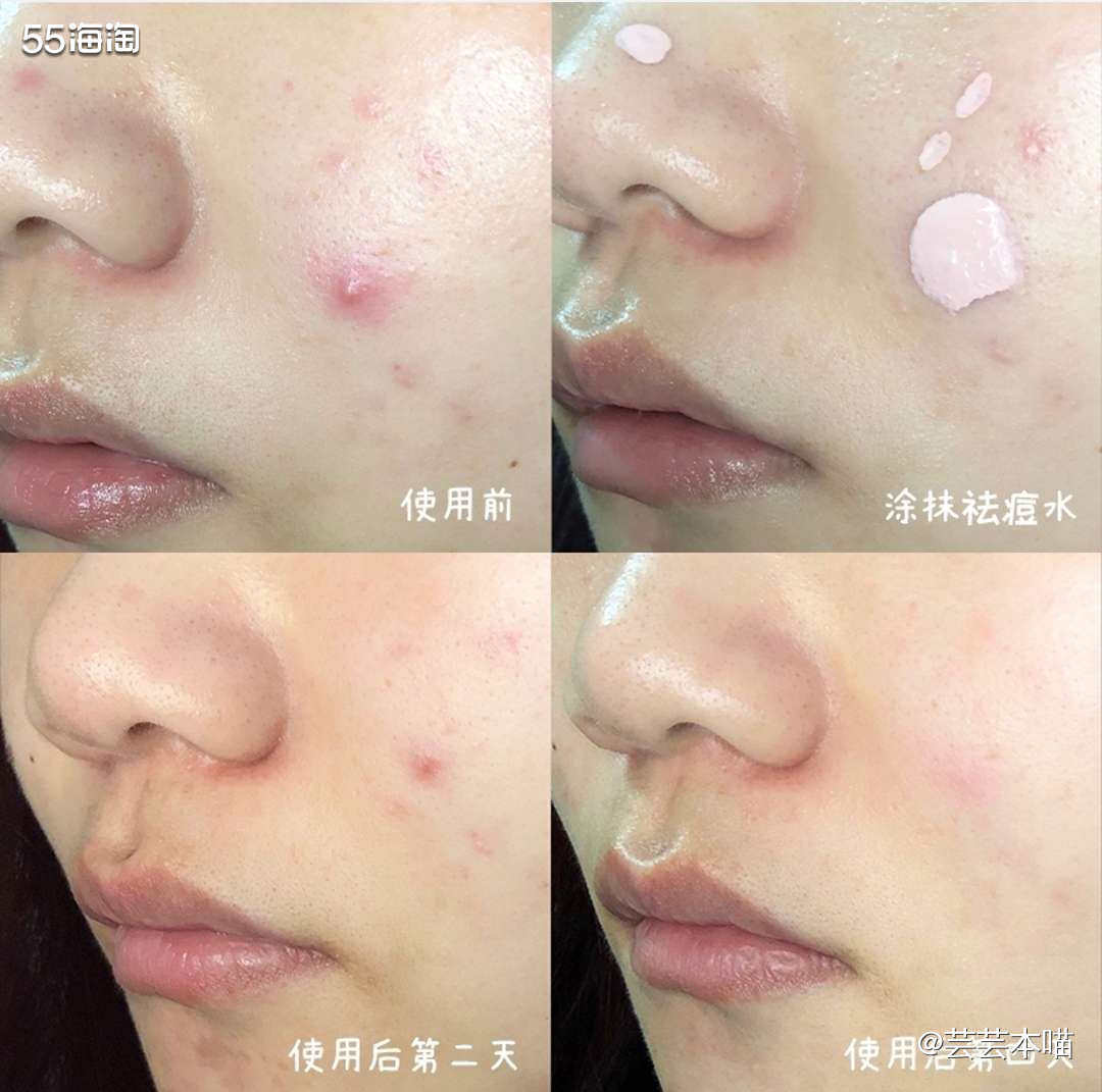 🌟这款Kate Somerville祛痘精华一瓶30ml，