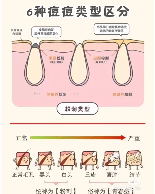 😅😅要入手痘肌好物，首先要弄清楚自己长的是什么类型的痘痘