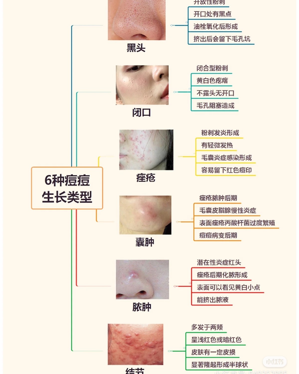😅😅要入手痘肌好物，首先要弄清楚自己长的是什么类型的痘痘