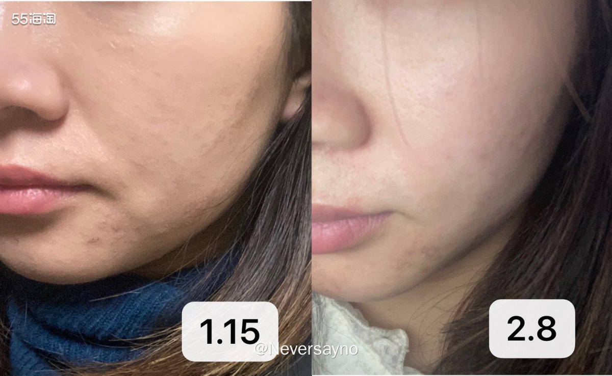 裴礼康水杨酸爽肤水试用测评，苹果自带前置无美颜  ♥️首先非