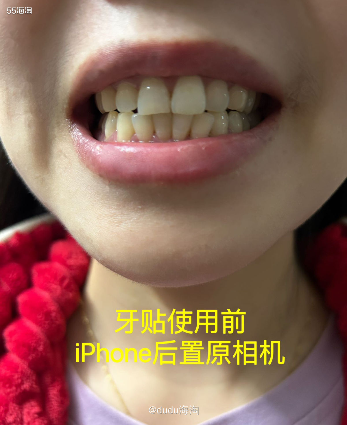 这次体验了SNOW变白牙贴，让我相信了牙贴真的不是智商税！！