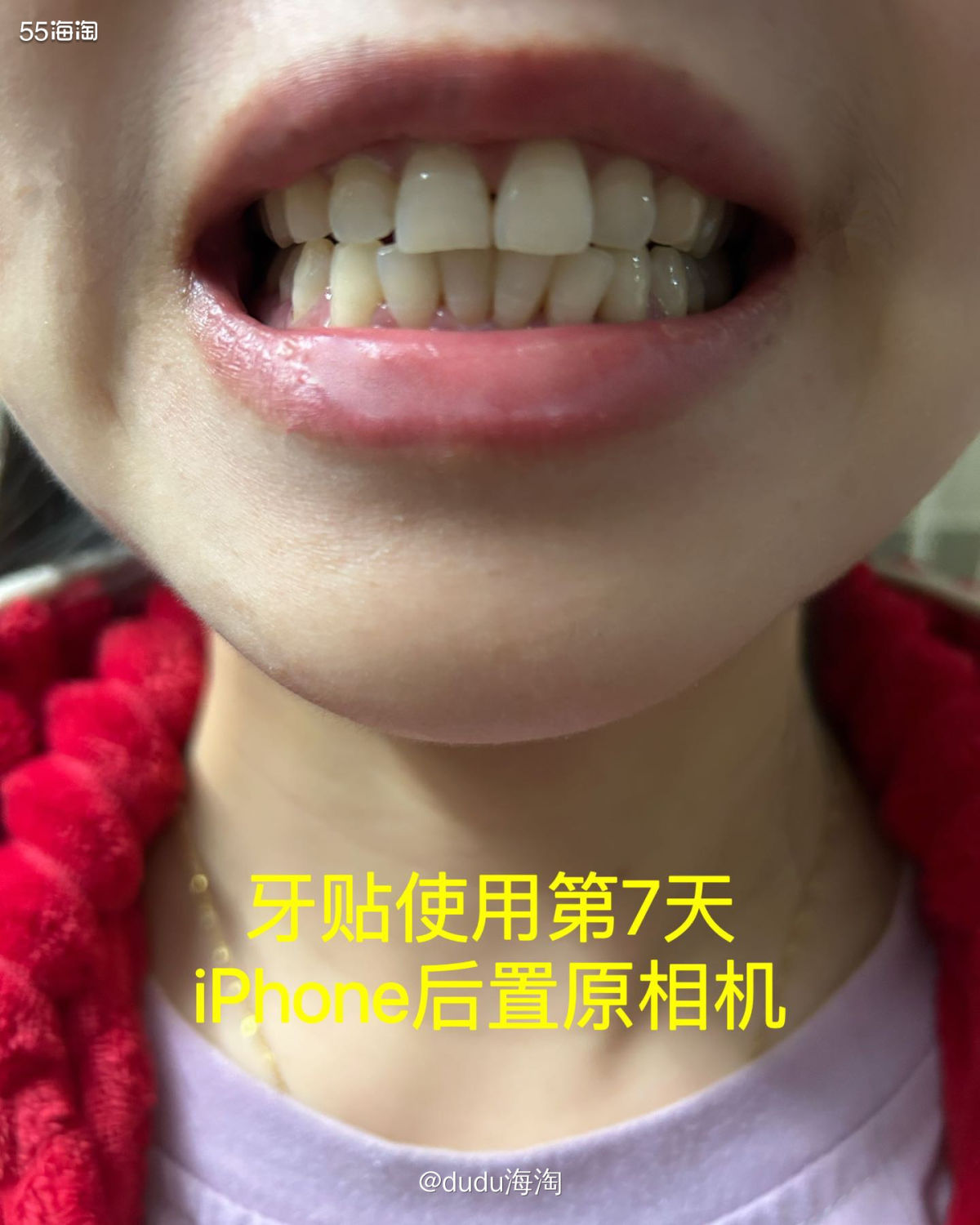 这次体验了SNOW变白牙贴，让我相信了牙贴真的不是智商税！！