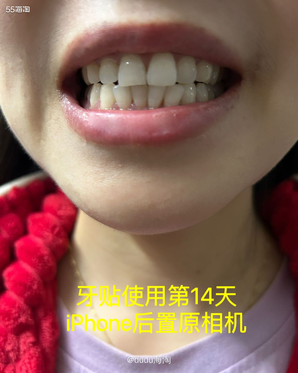 这次体验了SNOW变白牙贴，让我相信了牙贴真的不是智商税！！